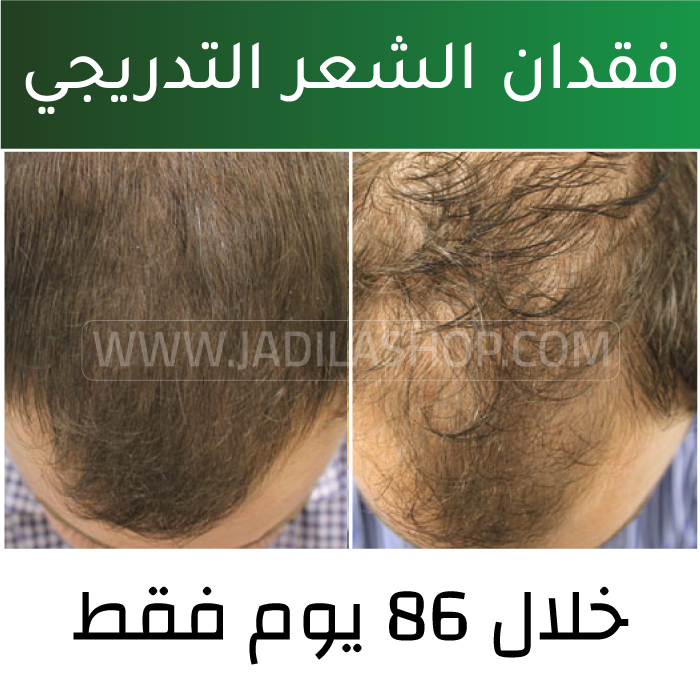 زيت الحشيش العلاج المثالي لكافة مشاكل الشعر 368741200